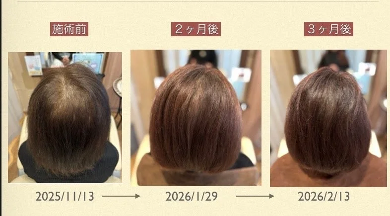 薄毛治療の経過を示すビフォーアフター画像。